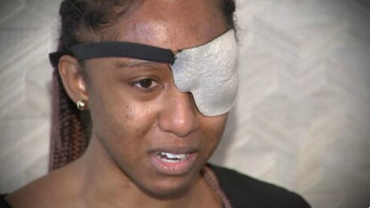 Filmmaker shot in eye with rubber bullet needs surgery